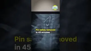 Thumbnail: Surat Civil Hospital | Open Safety Pin Removed from Baby’s Food Pipe via Endoscopy | Health Wealth