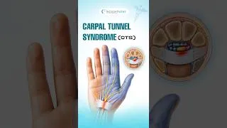 Thumbnail: Carpal Tunnel Syndrome Explained for Medical Coders | ICD-10-CM
