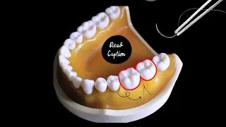 Thumbnail: Suturing in periodontal surgery