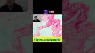 Thumbnail: Higher magnification of Fibrinous pericarditis. #Fibrinous #pericarditis #inflammation  #heart #lamb