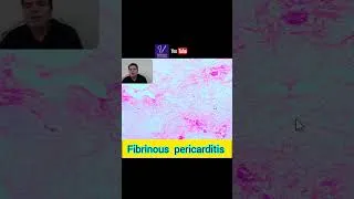 Thumbnail: Fibrinous pericarditis. #Fibrinous #pericarditis #inflammation #shorts #heart #lamb