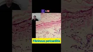 Thumbnail: Fibrinous pericarditis. #Fibrinous #pericarditis #inflammation #shorts #heart #lamb