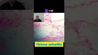 Thumbnail: Histopathological features of fibrinous pericarditis. #Fibrinous #pericarditis #inflammation #shorts