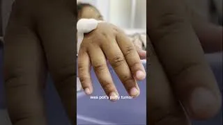 Thumbnail: 📚 Unveiling Medical Mysteries: Pott's Puffy Tumor Chronicles! 🧠✨
