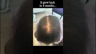 Thumbnail: She Thought Her Hair Would Never Grow Back